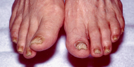 Toe nail fungal infection.